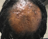 Alopecia secondary to Tinea Capitis